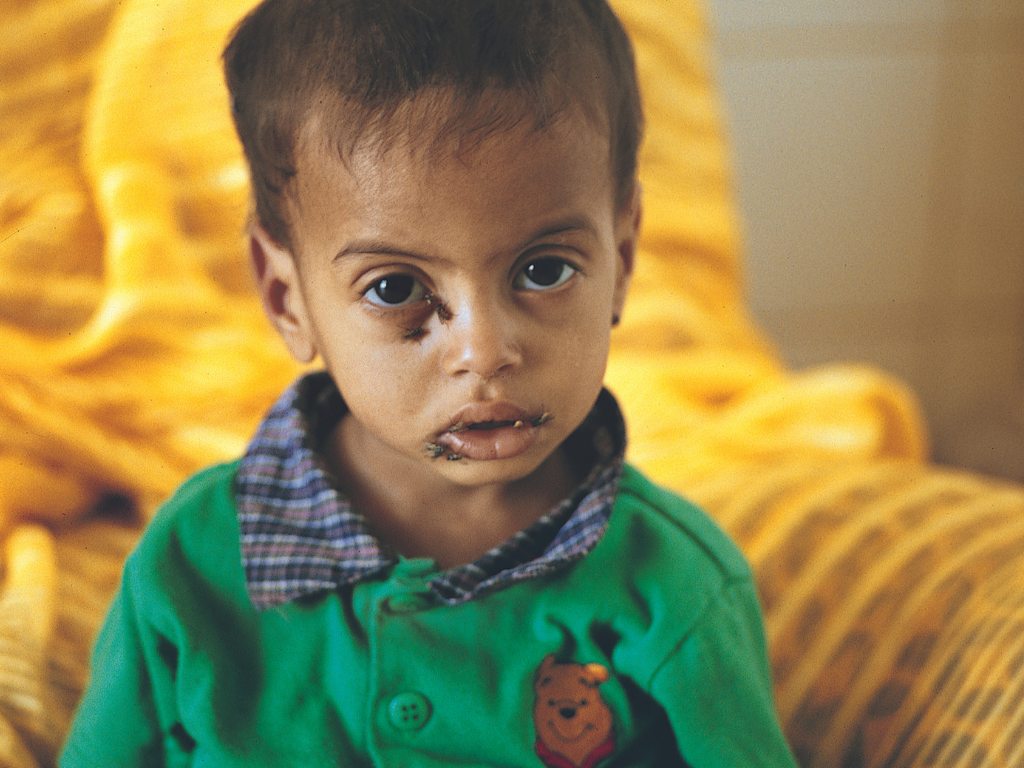 Se busca mejorar la calidad de vida de los niños/as y jóvenes con discapacidad servera.